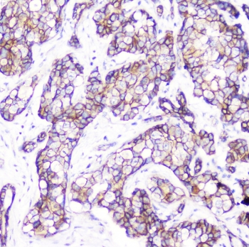 IHC testing of FFPE human breast cancer with Beta Catenin antibody. HIER: boil tissue sections in pH6, 10mM citrate buffer, for 10-20 min followed by cooling at RT for 20 min.