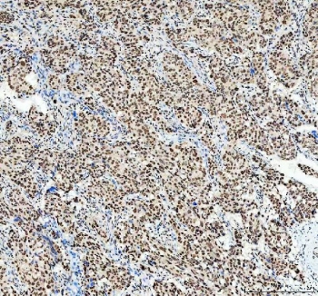 IHC staining of FFPE human ovarian cancer tissue with SP1 antibody. HIER: boil tissue sections in pH8 EDTA for 20 min and allow to cool before testing.