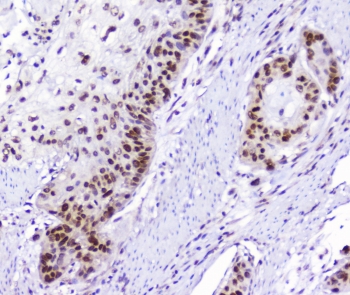AHR Antibody Esophageal Squamous Carcinoma IHC. Immunohistochemical staining of FFPE human esophageal squamous carcinoma demonstrates AHR expression using an AHR antibody at 1 ug/ml. AHR, also known as Aryl Hydrocarbon Receptor and an Environmental Sensor Protein, is a ligand activated transcription factor that regulates xenobiotic metabolism, inflammatory signaling, and cellular responses to endogenous metabolites. Prominent nuclear staining with accompanying cytoplasmic reactivity is observed in malignant squamous epithelial cells, consistent with activated AHR signaling and its emerging role in tumor progression and epithelial differentiation. Heat induced epitope retrieval was performed by boiling tissue sections in pH 6 10 mM citrate buffer for 10-20 minutes followed by cooling at room temperature for 20 minutes. These results support the utility of AHR Antibody for studies of carcinogenesis, transcriptional regulation, and environmental response pathways.