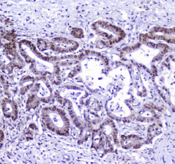AHR Antibody Cholangiocarcinoma IHC. Immunohistochemical staining of FFPE human cholangiocarcinoma demonstrates AHR expression using an AHR antibody at 1 ug/ml. AHR, also known as Aryl Hydrocarbon Receptor and an Environmental Sensor Protein, is a ligand activated transcription factor that integrates xenobiotic, dietary, and endogenous signals to regulate gene expression and cellular homeostasis. Strong nuclear and cytoplasmic staining is observed throughout malignant glandular epithelial cells, consistent with the involvement of AHR signaling in hepatic metabolism and biliary tract tumor biology. Heat induced epitope retrieval was performed by boiling tissue sections in pH 6 10 mM citrate buffer for 10-20 minutes followed by cooling at room temperature for 20 minutes. These findings support the utility of AHR Antibody for studies of hepatobiliary cancer, transcriptional regulation, and environmental sensing pathways.