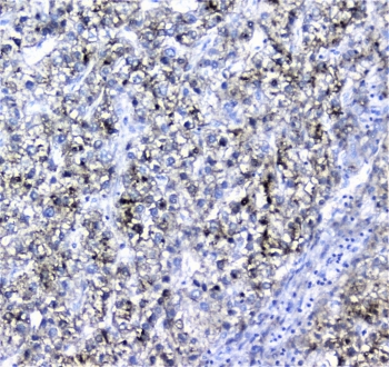 Alpha 1 Microglobulin Antibody Liver Cancer IHC. Immunohistochemistry analysis of FFPE human liver cancer tissue stained with Alpha 1 Microglobulin Antibody demonstrates granular cytoplasmic HRP-DAB brown staining within malignant epithelial cell populations, consistent with Alpha-1-microglobulin / AMBP-associated extracellular glycoprotein and secretory pathway expression. This Protein HC antibody highlights oxidative stress-associated signaling and plasma glycoprotein regulatory biology within hepatocellular tumor tissue. HIER: boil tissue sections in pH6, 10mM citrate buffer, for 10-20 min followed by cooling at RT for 20 min.