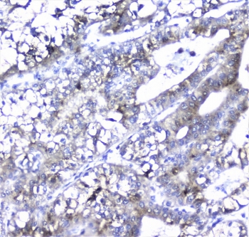 Alpha 1 Microglobulin Antibody Liver Carcinoma IHC. Immunohistochemistry analysis of FFPE human liver carcinoma tissue stained with Alpha 1 Microglobulin Antibody demonstrates diffuse cytoplasmic HRP-DAB brown staining in tumor epithelial cells with heterogeneous intensity across neoplastic glandular structures, consistent with Alpha-1-microglobulin / AMBP-associated secretory protein expression. This Protein HC antibody highlights extracellular glycoprotein-associated signaling and oxidative stress regulatory pathways in liver-derived tumor tissue. HIER: boil tissue sections in pH6, 10mM citrate buffer, for 10-20 min followed by cooling at RT for 20 min.