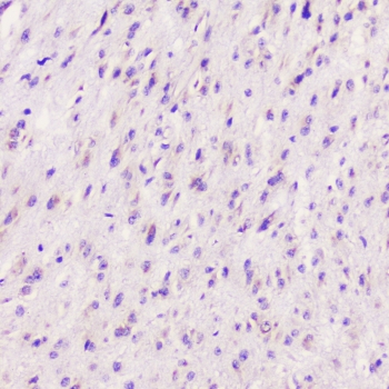 IHC staining of FFPE human glioma with ELAVL2 antibody at 1ug/ml. HIER: boil tissue sections in pH6, 10mM citrate buffer, for 10-20 min followed by cooling at RT for 20 min.