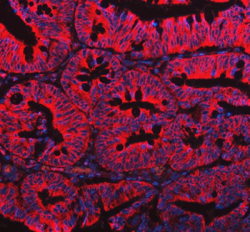 Immunofluorescent staining of FFPE human colorectal cancer tissue with EML4 antibody (red) and DAPI nuclear stain (blue). HIER: steam section in pH8 EDTA buffer for 20 min.