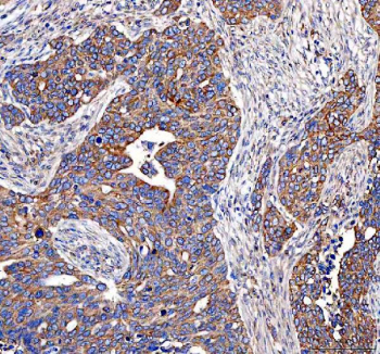 IHC staining of FFPE human ovarian serous adenocarcinoma tissue with EML4 antibody. HIER: boil tissue sections in pH8 EDTA for 20 min and allow to cool before testing.