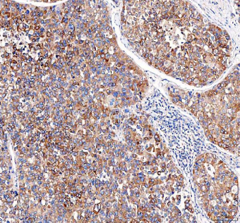IHC staining of FFPE human liver cancer tissue with EML4 antibody. HIER: boil tissue sections in pH8 EDTA for 20 min and allow to cool before testing.