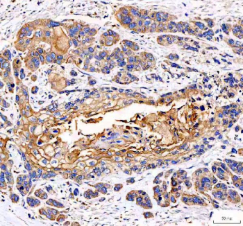 IHC staining of FFPE human esophageal squamous carcinoma tissue with EML4 antibody. HIER: boil tissue sections in pH8 EDTA for 20 min and allow to cool before testing.