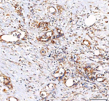 IHC staining of FFPE human colorectal adenocarcinoma tissue with EML4 antibody. HIER: boil tissue sections in pH8 EDTA for 20 min and allow to cool before testing.