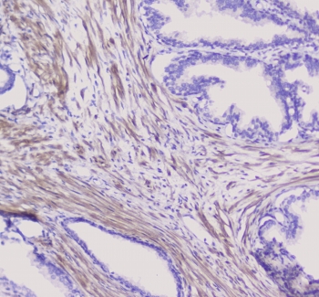 NSE Antibody Human Pancreatic Cancer IHC. Immunohistochemistry staining of FFPE human pancreatic cancer with NSE antibody at 1ug/ml. HIER: boil tissue sections in pH6, 10mM citrate buffer, for 10-20 min followed by cooling at RT for 20 min.