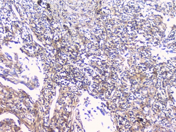 CD32 Antibody Lung Cancer IHC. Immunohistochemistry staining of FFPE human lung cancer with CD32 antibody at 1ug/ml. HIER: boil tissue sections in pH6, 10mM citrate buffer, for 10-20 min followed by cooling at RT for 20 min.