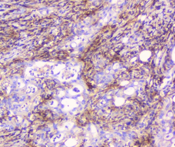 CD32 Antibody Rectal Cancer IHC. Immunohistochemistry staining of FFPE human rectal cancer with CD32 antibody at 1ug/ml. HIER: boil tissue sections in pH6, 10mM citrate buffer, for 10-20 min followed by cooling at RT for 20 min.
