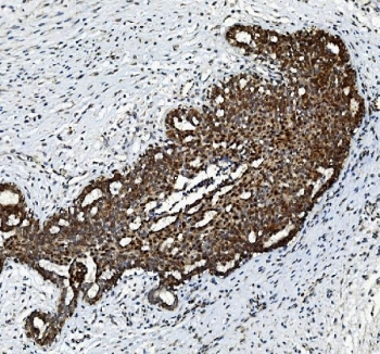 IHC staining of FFPE human breast cancer tissue with FGF2 antibody. HIER: boil tissue sections in pH8 EDTA for 20 min and allow to cool before testing.