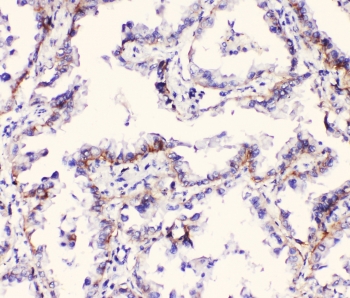 IHC staining of FFPE human lung cancer with ITGA3 antibody at 1ug/ml. HIER: boil tissue sections in pH6, 10mM citrate buffer, for 10-20 min followed by cooling at RT for 20 min.