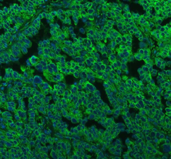 Immunofluorescent staining of FFPE human ovarian cancer tissue with LMAN1 antibody (green) and DAPI nuclear stain (blue). HIER: steam section in pH8 EDTA buffer for 20 min.