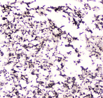 IHC staining of FFPE human glioma with UBC9 antibody at 1ug/ml. HIER: boil tissue sections in pH6, 10mM citrate buffer, for 10-20 min followed by cooling at RT for 20 min.