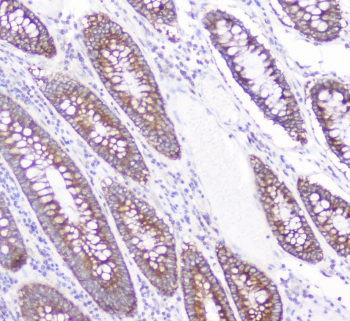 IHC staining of FFPE human colon cancer with CD2AP antibody at 1ug/ml. HIER: boil tissue sections in pH6, 10mM citrate buffer, for 10-20 min followed by cooling at RT for 20 min.