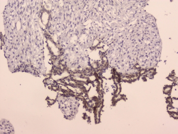 IHC staining of FFPE human breast cancer with LRIG1 antibody at 2ug/ml. HIER: boil tissue sections in pH6, 10mM citrate buffer, for 10-20 min followed by cooling at RT for 20 min.
