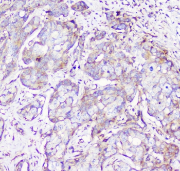 IHC staining of FFPE human breast cancer with RP2 antibody at 1ug/ml. HIER: boil tissue sections in pH6, 10mM citrate buffer, for 10-20 min followed by cooling at RT for 20 min.