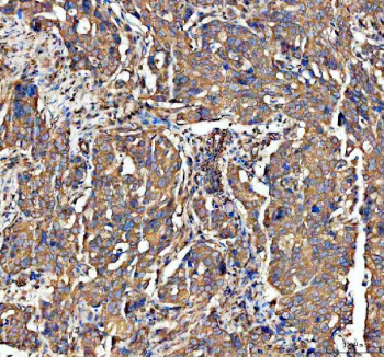 IHC staining of FFPE human ovarian serous adenocarcinoma tissue with ADAM10 antibody, HRP-secondary and DAB substrate. HIER: boil tissue sections in pH8 EDTA for 20 min and allow to cool before testing.