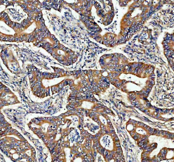 IHC staining of FFPE human rectum adenocarcinoma tissue with ADAM10 antibody, HRP-secondary and DAB substrate. HIER: boil tissue sections in pH8 EDTA for 20 min and allow to cool before testing.