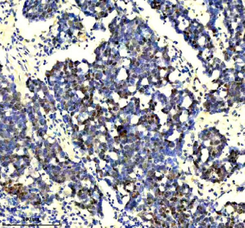 IHC staining of FFPE human skin cancer tissue with p73 antibody, HRP-labeled secondary and DAB substrate. HIER: boil tissue sections in pH8 EDTA for 20 min and allow to cool before testing.