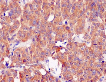 IHC staining of human thyroid carcinoma with CLOCK antibody. HIER: boil tissue sections in pH6, 10mM citrate buffer, for 10-20 min and allow to cool before testing.