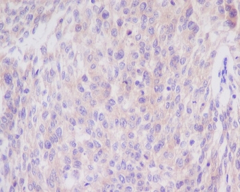 IHC staining of FFPE human cervix with BCL2L11 antibody. HIER: boil tissue sections in pH6, 10mM citrate buffer, for 10-20 min and allow to cool before testing.