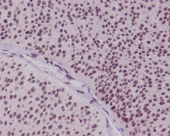 IHC staining of FFPE human bladder carcinoma with FOXO3A antibody. HIER: boil tissue sections in pH6, 10mM citrate buffer, for 10-20 min and allow to cool before testing.