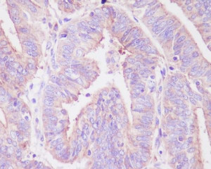Phospho-FOXO3A (S253) Antibody Human Uterine Cancer IHC. Phospho-FOXO3A (S253) Antibody was used for immunohistochemical staining of FFPE human uterine cancer tissue. Following antigen retrieval, the tissue was incubated with the phospho-specific primary antibody, followed by an HRP-conjugated secondary antibody and chromogenic detection. Predominantly cytoplasmic staining is observed in the malignant epithelial cells, consistent with phosphorylation of FOXO3A at serine 253, an event that promotes nuclear export and transcriptional inactivation through AKT signaling. This Phospho-FOXO3A (S253) Antibody / Phosphorylated FOXO3A Antibody is well suited for investigating PI3K/AKT pathway activation, FOXO3A phosphorylation, growth factor signaling, and phosphorylation-dependent regulation of tumor biology.