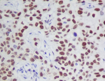 Phospho-JAK2 Antibody Human Tissue IHC. Immunohistochemistry analysis of FFPE human tissue stained with phospho-JAK2 antibody detecting JAK2 phosphorylated at Tyr1007 and Tyr1008, clone IFE-10. Cells show nuclear and cytoplasmic HRP-DAB brown staining, consistent with activation of JAK-STAT signaling pathways, with nuclear signal reflecting downstream transcriptional activity. Nuclei are counterstained blue. HIER: boil tissue sections in pH6, 10 mM citrate buffer for 10-20 minutes followed by cooling.