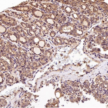 EGFR Antibody Thyroid Cancer IHC. Immunohistochemistry staining of FFPE human thyroid cancer with EGFR antibody. HIER: boil tissue sections in pH6, 10mM citrate buffer, for 10-20 min and allow to cool before testing.
