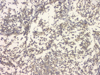 IHC staining of FFPE human glioma with APP antibody at 1ug/ml. HIER: boil tissue sections in pH6, 10mM citrate buffer, for 10-20 min and allow to cool before testing.