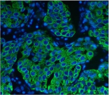 Keratin 8 Antibody Breast Cancer IF. Immunofluorescent staining of FFPE human breast cancer tissue using Keratin 8 Antibody demonstrates strong green cytoplasmic and membranous staining throughout malignant epithelial cell populations. The staining pattern is consistent with expression of Cytokeratin 8 (CK8/KRT8), a type II intermediate filament protein commonly expressed in epithelial tissues and epithelial-derived carcinomas. CK8 immunoreactivity highlights tumor cell morphology, epithelial differentiation, and cytoskeletal organization, while DAPI (blue) counterstains cell nuclei. HIER: steam tissue sections in pH 8 EDTA buffer for 20 minutes prior to staining.