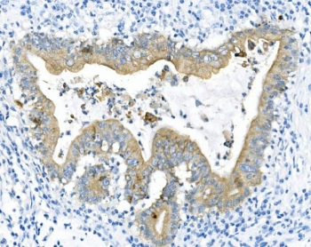 Keratin 8 Antibody Rectal Cancer IHC. Immunohistochemical staining of FFPE human rectal cancer tissue using Keratin 8 Antibody demonstrates membranous and cytoplasmic HRP-DAB brown staining within malignant epithelial cells lining gland-forming tumor structures. The staining pattern is consistent with expression of Cytokeratin 8 (CK8/KRT8), a type II intermediate filament protein widely expressed in simple epithelial tissues and epithelial-derived carcinomas. CK8 immunoreactivity highlights neoplastic epithelial architecture and supports evaluation of epithelial differentiation in rectal cancer specimens. HIER: boil tissue sections in pH 8 EDTA buffer for 20 minutes and allow to cool before testing.