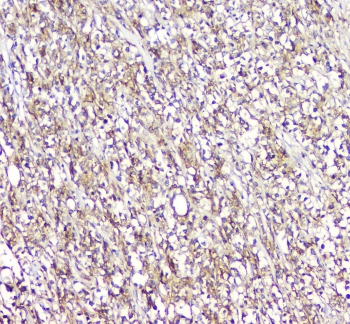 L-Plastin Antibody Human Lymphocytic Tumor IHC. IHC staining of FFPE human lymphocytic tumor tissue with L-Plastin antibody demonstrated widespread cytoplasmic and membranous staining of neoplastic lymphoid cells, consistent with the expression pattern of L-plastin (LCP1), a leukocyte-specific actin-bundling protein involved in immune cell activation and migration. L-plastin serves as a marker of hematopoietic cells and is frequently expressed in lymphoid malignancies. The diffuse staining pattern observed is consistent with the cytoskeletal remodeling and migratory properties characteristic of lymphocytic tumors. Immunostaining was performed with L-Plastin antibody at 1 ug/ml following heat-induced epitope retrieval by boiling tissue sections in pH 6, 10 mM citrate buffer for 10-20 minutes and allowing them to cool before testing.