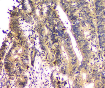 IHC staining of FFPE human colon cancer tissue with PTPN11 antibody, HRP-secondary and DAB substrate. HIER: boil tissue sections in pH8 EDTA for 20 min and allow to cool before testing.