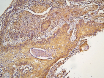 IHC staining of FFPE human esophageal squamous cancer with HOOK3 antibody at 1ug/ml. HIER: boil tissue sections in pH6, 10mM citrate buffer, for 10-20 min and allow to cool before testing.