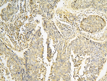 IHC staining of FFPE human lung cancer with CPAMD8 antibody at 1ug/ml. HIER: boil tissue sections in pH6, 10mM citrate buffer, for 10-20 min and allow to cool before testing.