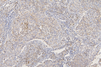 IHC staining of FFPE human lung cancer with SFRP1 antibody at 1ug/ml. HIER: boil tissue sections in pH6, 10mM citrate buffer, for 10-20 min and allow to cool before testing.