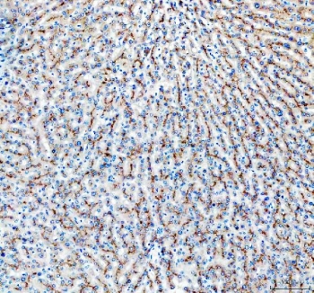 IHC staining of FFPE human liver cancer with MRP2 antibody. HIER: boil tissue sections in pH8 EDTA buffer for 10-20 min and allow to cool before testing.