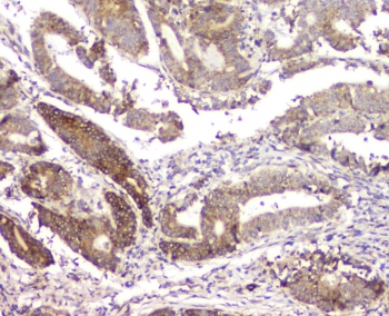 IHC staining of FFPE human intestinal cancer with RMI2 antibody at 1ug/ml. HIER: boil tissue sections in pH6, 10mM citrate buffer, for 10-20 min and allow to cool before testing.
