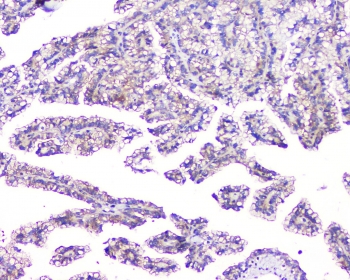 IHC staining of FFPE human renal cancer with TMEM166 antibody at 1ug/ml. HIER: boil tissue sections in pH6, 10mM citrate buffer, for 10-20 min and allow to cool before testing.