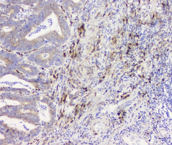 IHC staining of FFPE human intestinal cancer with RRBP1 antibody at 1ug/ml. HIER: boil tissue sections in pH6, 10mM citrate buffer, for 10-20 min and allow to cool before testing.