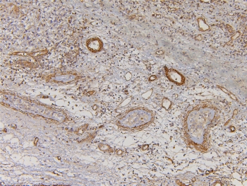 IHC staining of FFPE human testis cancer with EHD1 antibody. HIER: boil tissue sections in pH6, 10mM citrate buffer, for 10-20 min and allow to cool before testing.