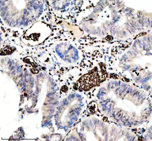 CD235a Antibody in Human Colon Cancer IHC. Immunohistochemistry testing of CD235a Antibody ADOG-7 / Erythroid Marker Antibody in FFPE human colon cancer tissue. Heat-induced epitope retrieval was performed in EDTA buffer, pH 8.0, followed by blocking with 10% goat serum. The antibody was used at 1:100 overnight at 4oC, followed by peroxidase-conjugated goat anti-rabbit IgG and DAB detection. Strong staining is observed predominantly in erythrocytes within vascular spaces, while the surrounding colonic epithelial cells show little staining.