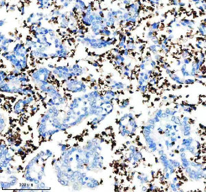 CD235a Antibody in Human Lung Cancer IHC. Immunohistochemistry testing of CD235a Antibody ADOG-7 / Erythroid Marker Antibody in FFPE human lung cancer tissue. Heat-induced epitope retrieval was performed in EDTA buffer, pH 8.0, followed by blocking with 10% goat serum. The antibody was used at 1:100 overnight at 4oC, followed by peroxidase-conjugated goat anti-rabbit IgG and DAB detection. Strong staining is concentrated in numerous small cells consistent with erythrocytes, while the larger tumor epithelial cells show comparatively little immunoreactivity.