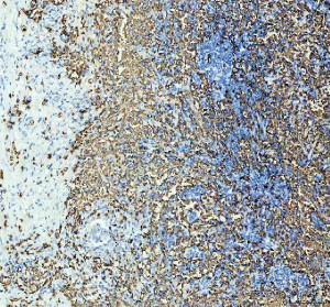 CD235a Antibody in Human Lung Cancer Tissue IHC. Immunohistochemistry testing of CD235a Antibody ADOG-7 / Erythroid Marker Antibody in a second FFPE human lung cancer tissue section. Heat-induced epitope retrieval was performed in EDTA buffer, pH 8.0, and the antibody was used at 1:100 overnight at 4oC. Widespread immunoreactivity is visible throughout the tissue, including numerous small cells within the tumor-associated stroma.