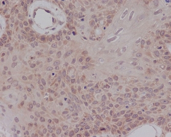 ER alpha Antibody Cervical Carcinoma IHC. Immunohistochemistry staining of FFPE human cervical carcinoma with ER alpha antibody. HIER: boil tissue sections in pH6, 10mM citrate buffer, for 10-20 min and allow to cool before testing.