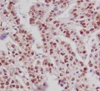 Phospho-ER alpha (pS118) Antibody Kidney Tissue IHC. Immunohistochemistry of FFPE human kidney tissue using phospho-ER alpha (pS118) antibody shows HRP-DAB brown nuclear staining in epithelial cells, consistent with phosphorylation at serine 118 and activation of ESR1 signaling, while surrounding stromal elements display lower background; detection was performed with clone EIG-5. HIER: boil tissue sections in pH6 citrate buffer for 20 min and allow to cool before testing.