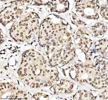 Phospho-ER alpha (pS118) Antibody Breast Cancer Tissue IHC. Immunohistochemistry of FFPE human breast carcinoma tissue using phospho-ER alpha (pS118) antibody shows prominent HRP-DAB brown nuclear staining in tumor epithelial cells, consistent with hormone- and growth factor-induced phosphorylation at serine 118 and active ESR1 signaling, while surrounding stromal cells display lower background; detection was performed with clone EIG-5. HIER: boil tissue sections in pH8 EDTA for 20 min and allow to cool before testing.